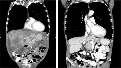 Triple-Regimen of Vemurafenib, Irinotecan, and Cetuximab for the Treatment of BRAFV600E-Mutant CRC: A Case Report and Review